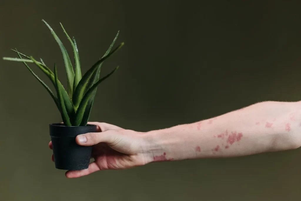 A hand holding a potted aloe vera plant, with another arm showing visible eczema patches