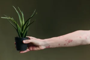 A hand holding a potted aloe vera plant, with another arm showing visible eczema patches