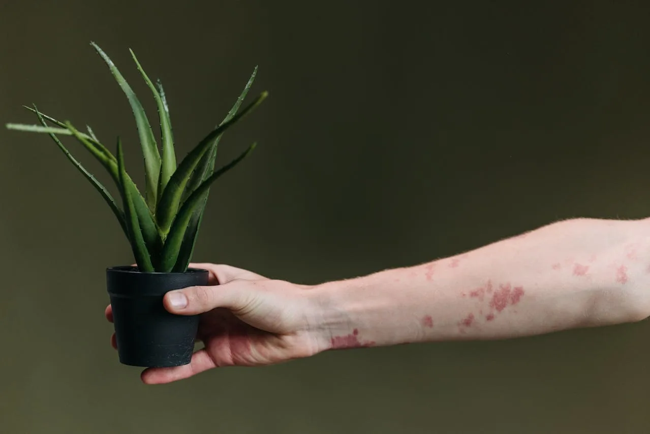 A hand holding a potted aloe vera plant, with another arm showing visible eczema patches